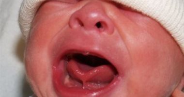 Si la langue de votre bébé est attachée : signes à ne pas ignorer et 3 méthodes de traitement