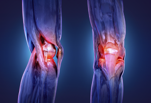 إشعاع منخفض الجرعة يفتح آفاقا لعلاج ألم الركبة المزمن