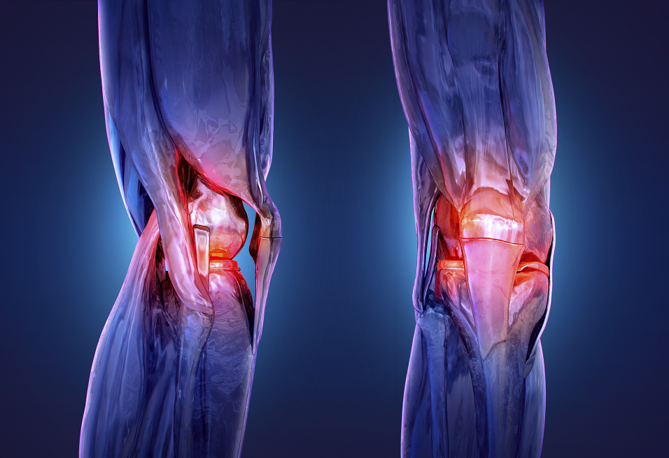 إشعاع منخفض الجرعة يفتح آفاقا لعلاج ألم الركبة المزمن