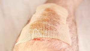 Jusqu'à 10 000 fois plus efficace !.. Nouvelle approche thérapeutique améliore l'efficacité des antibiotiques contre les plaies chroniques