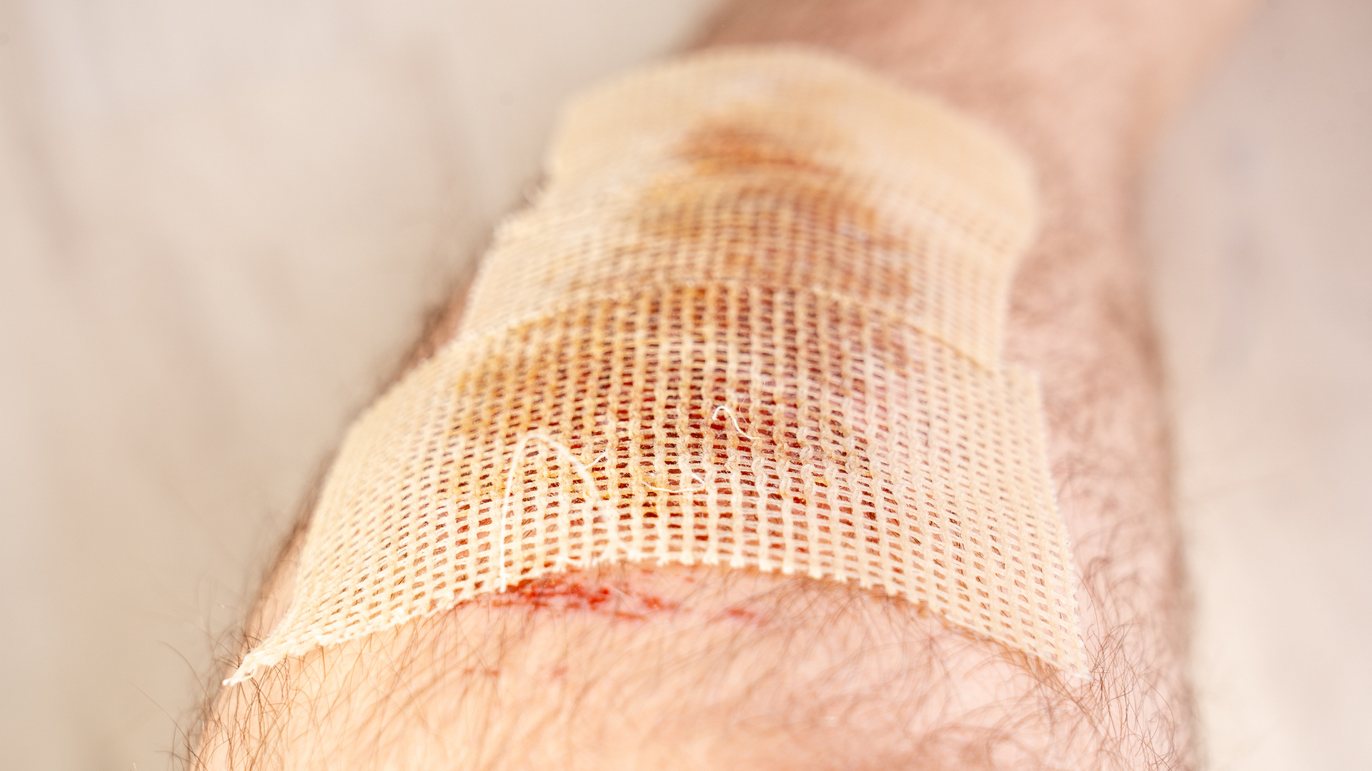 يصل إلى 10 آلاف ضعف!.. نهج علاجي جديد يعزز فعالية المضادات الحيوية لمكافحة الجروح المزمنة