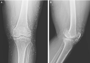 Severe Knee Pain in Woman Reveals "Golden Threads" in Her Joints