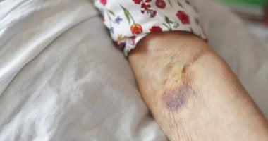 Causé par un excès de fer : Qu'est-ce que l'hémochromatose - Youm7